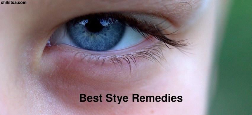 Best Stye Remedies