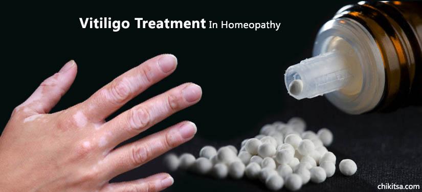 Vitiligo Treatment In Homeopathy
