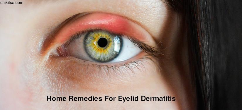 Home Remedies For Eyelid Dermatitis