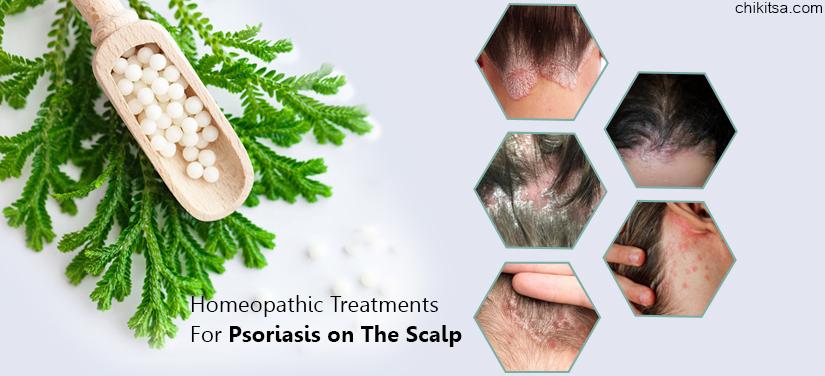 Homeopathic Treatments For Psoriasis On The Scalp