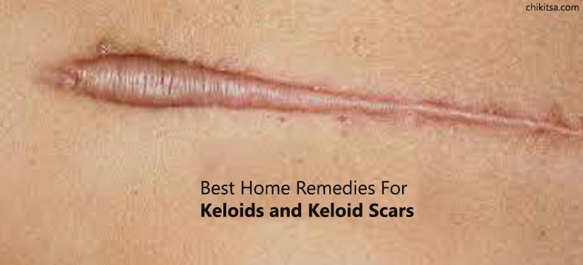 Home remedies for Keloids