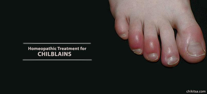Homeopathic Treatment for Chilblains