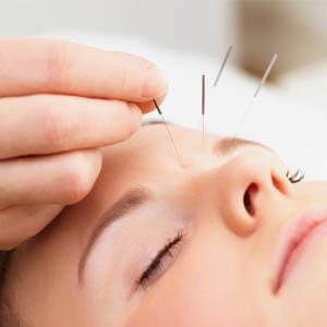 Acupuncture for Migraine