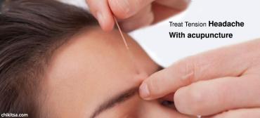 Acupuncture For Your Tension Headache