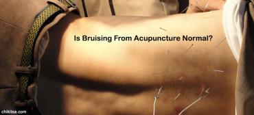 Bruising From Acupuncture