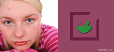 How To Beat Down Acne With Ayurveda