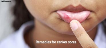 Top 7 Effective Home Remedies For Canker Sores